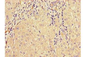 Immunohistochemistry of paraffin-embedded human liver cancer using ABIN7159734 at dilution of 1:100 (MTTP anticorps  (AA 19-151))