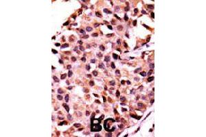 Formalin-fixed and paraffin-embedded human breast cancer tissue reacted with PPP3CC polyclonal antibody  , which was peroxidase-conjugated to the secondary antibody, followed by AEC staining. (PPP3CC anticorps  (N-Term))