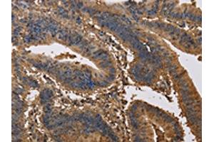 The image on the left is immunohistochemistry of paraffin-embedded Human colon cancer tissue using ABIN7191171(KCNG1 Antibody) at dilution 1/40, on the right is treated with synthetic peptide. (KCNG1 anticorps)