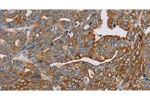 Immunohistochemistry of paraffin-embedded Human cervical cancer using MTFP1 Polyclonal Antibody at dilution of 1:30