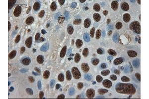 Immunohistochemical staining of paraffin-embedded Adenocarcinoma of breast using anti-AMY2A (ABIN2452539) mouse monoclonal antibody. (AMY2A anticorps  (AA 300-511))