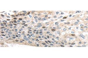 Immunohistochemistry of paraffin-embedded Human esophagus cancer using TPX2 Polyclonal Antibody at dilution of 1/40