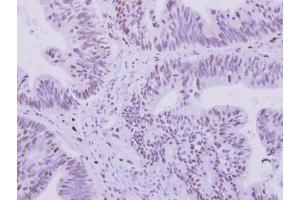 IHC-P Image 53BP1 antibody [N1], N-term detects 53BP1 protein at nucleus on human colon carcinoma by immunohistochemical analysis.