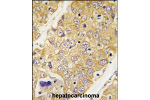 Formalin-fixed and paraffin-embedded human hepatocellular carcinoma reacted with Dtnbp1 polyclonal antibody  , which was peroxidase-conjugated to the secondary antibody, followed by DAB staining.