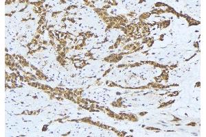 ABIN6275640 at 1/100 staining Human lung cancer tissue by IHC-P. (MTERF anticorps  (Internal Region))