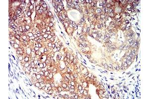 Immunohistochemical analysis of paraffin-embedded cervical cancer tissues using CD195 mouse mAb with DAB staining.