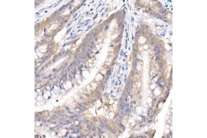 Immunohistochemistry of paraffin-embedded human colon carcinoma using SARA Rabbit mAb (ABIN7271559) at dilution of 1:50 (40x lens). (ZFYVE9 anticorps)