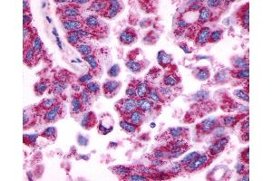 Anti-MRGPRE / MRGE antibody IHC of human Lung, Adenocarcinoma. (MRGPRE anticorps  (C-Term))