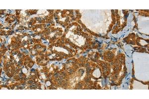 Immunohistochemistry of paraffin-embedded Human thyroid cancer tissue using NPAP1 Polyclonal Antibody at dilution 1:60 (NPAP1 anticorps)