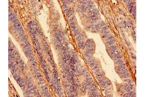 Immunocytochemistry analysis of human colon cancer using ABIN7156029 at dilution of 1:100