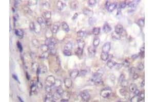 Immunohistochemistry analyzes of C-Raf antibody in paraffin-embedded human breast carcinoma tissue. (RAF1 anticorps)