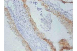 Immunohistochemistry of paraffin-embedded Rat prostate cancer using ABIN7179094 at dilution of 1:100. (TIMP1 anticorps)