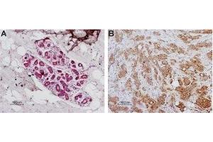 Expression of PAR-1 in normal human breast and human breast carcinoma - Immunohistochemical staining of paraffin-embedded human breast sections using Anti-Human PAR1 (F2R) (extracellular) Antibody (ABIN7043073, ABIN7045102 and ABIN7045103), (1:100).