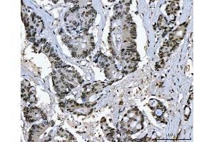 IHC analysis of Ki67/MKI67 using anti-Ki67/MKI67 antibody (ABIN7601873). (Ki-67 anticorps  (AA 5-2358))