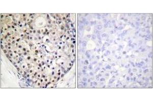 Immunohistochemistry analysis of paraffin-embedded human breast carcinoma, using CHOP (Phospho-Ser30) Antibody. (DDIT3 anticorps  (pSer30))