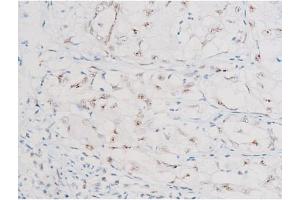 ABIN6267602 at 1/200 staining Human liver cancer tissue sections by IHC-P.