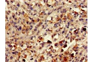 Immunohistochemistry of paraffin-embedded human melanoma using ABIN7154456 at dilution of 1:100 (PLA2G10 anticorps  (AA 43-165))