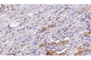 ABIN6272632 at 1/100 staining Human liver cancer tissue by IHC-P. (CD300LB anticorps  (C-Term))