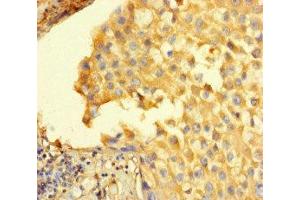 Immunohistochemistry of paraffin-embedded human breast cancer using ABIN7168626 at dilution of 1:100 (STIL anticorps  (AA 388-637))