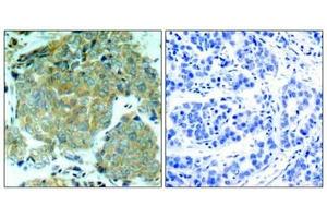 Immunohistochemical analysis of paraffin-embedded human breast carcinoma tissue using eIF2α (Phospho-Ser51) Antibody (left) or the same antibody preincubated with blocking peptide (right). (EIF2S1 anticorps  (pSer51))