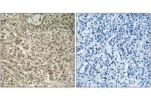 Immunohistochemistry analysis of paraffin-embedded human breast carcinoma tissue, using RPL40 Antibody. (UBA52 anticorps  (AA 71-120))