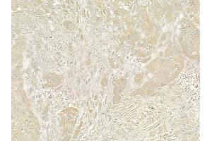 ABIN6260408 and ABIN6273204 at 1/100 staining human tongue carcinoma by IHC-P. (CALCOCO2 anticorps  (Internal Region))