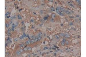 Detection of AT in Human Breast cancer Tissue using Monoclonal Antibody to Antithrombin (AT)