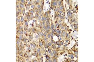 Immunohistochemistry of paraffin-embedded human lung cancer using SHMT2 antibody at dilution of 1:100 (400x lens). (SHMT2 anticorps)