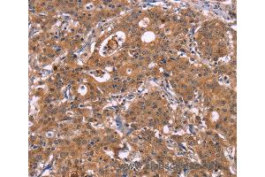 Immunohistochemistry of Human liver cancer using HMGCS1 Polyclonal Antibody at dilution of 1:40