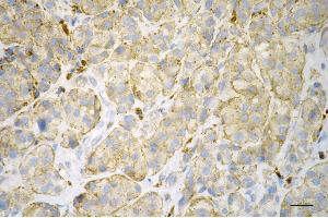 Immunohistochemistry was performed on paraffin-embedded human melanoma using ITGB1BP1 antibody (ABIN7799068), 1:200). (ITGB1BP1 anticorps)