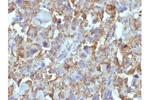 Formalin-fixed, paraffin-embedded human Histiocytoma stained with Macrophage Monoclonal Antibody (D11). (Macrophage / Histiocytoma Marker anticorps)