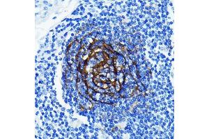 Immunohistochemistry of paraffin-embedded human lung cancer using p75NTR/NGFR Rabbit mAb (ABIN7268850) at dilution of 1:100 (40x lens). (NGFR anticorps)