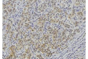 ABIN6273513 at 1/100 staining Human lung cancer tissue by IHC-P. (LAMC3 anticorps  (Internal Region))