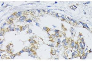 Immunohistochemistry of paraffin-embedded Human mammary cancer using SLC30A1 Polyclonal Antibody at dilution of 1:100 (40x lens). (SLC30A1 anticorps)