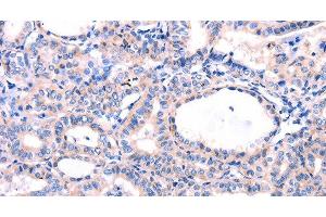 Immunohistochemistry of paraffin-embedded Human thyroid cancer tissue using DUSP12 Polyclonal Antibody at dilution 1:77 (DUSP12 anticorps)