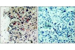 Immunohistochemistry analysis of paraffin-embedded human breast carcinoma tissue, using JAK1 (Ab-1022) Antibody. (JAK1 anticorps  (AA 988-1037))
