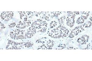 Immunohistochemistry of paraffin-embedded Human esophagus cancer tissue using BRD3 Polyclonal Antibody at dilution of 1:60(x200) (BRD3 anticorps)