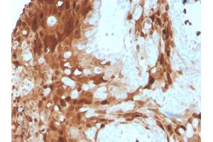 Formalin-fixed, paraffin-embedded human skin carcinoma stained with Calprotectin Mouse Monoclonal Antibody (S100A9/1075). (S100A9 anticorps)