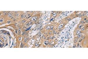 Immunohistochemistry of paraffin-embedded Human esophagus cancer tissue using PA2G4 Polyclonal Antibody at dilution of 1:60(x200) (PA2G4 anticorps)