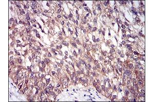 Immunohistochemical analysis of paraffin-embedded bladder cancer tissues using DIS3L2 mouse mAb with DAB staining. (DIS3L2 anticorps  (AA 27-250))