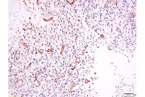 Formalin-fixed and paraffin embedded human neurological glioblastoma labeled with Anti-OPRD1 (Ser363) Polyclonal Antibody, Unconjugated  at 1:200 followed by conjugation to the secondary antibody and DAB staining.
