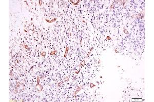 Formalin-fixed and paraffin embedded human neurological glioblastoma labeled with Anti-OPRD1 (Ser363) Polyclonal Antibody, Unconjugated  at 1:200 followed by conjugation to the secondary antibody and DAB staining.