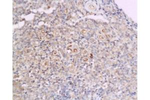 Formalin-fixed and paraffin embedded human flat moss tinea tissue labeled with Anti-Cyclin D2 Polyclonal Antibody, Unconjugated  at 1:200 followed by conjugation to the secondary antibody and DAB staining