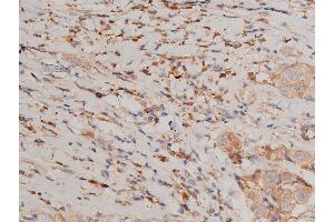ABIN6267231 at 1/200 staining human breast cancer tissue sections by IHC-P. (IKK alpha anticorps  (pSer176, pSer177))
