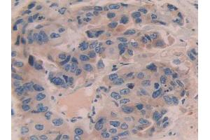 IHC-P analysis of Human Breast Cancer Tissue, with DAB staining. (Contactin 4 anticorps  (AA 731-980))