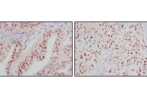 Immunohistochemical analysis of paraffin-embedded human ovarian cancer (left) and breast cancer (right) tissues using ATP2C1 mouse mAb with DAB staining. (ATP2C1 anticorps)