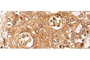 Immunohistochemistry of paraffin-embedded Human prost ate cancer tissue using ZPR1 Polyclonal Antibody at dilution of 1:40(x200) (ZNF259 anticorps)