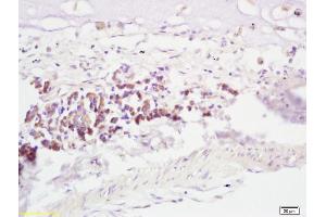 Formalin-fixed and paraffin embedded human lung carcinoma labeled with Anti-RNF43 Polyclonal Antibody, Unconjugated (ABIN721600) at 1:200, followed by conjugation to the secondary antibody and DAB staining (RNF43 anticorps  (AA 41-140))
