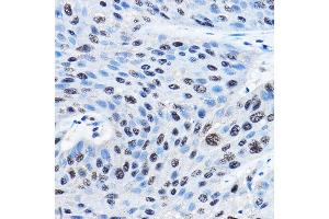 Immunohistochemistry of paraffin-embedded human esophageal cancer using NUDT21 Rabbit pAb (ABIN1681134, ABIN3018973, ABIN3018974 and ABIN6220652) at dilution of 1:100 (40x lens). (NUDT21 anticorps  (AA 1-227))