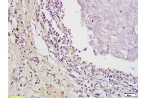 Formalin-fixed and paraffin embedded human breast carcinoma labeled with Rabbit Anti EMR1 Polyclonal Antibody, Unconjugated (ABIN1387314) at 1:200 followed by conjugation to the secondary antibody and DAB staining (F4/80 anticorps  (AA 732-747))